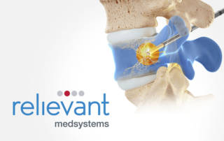 Relievant Smart Trial Intracept Procedure